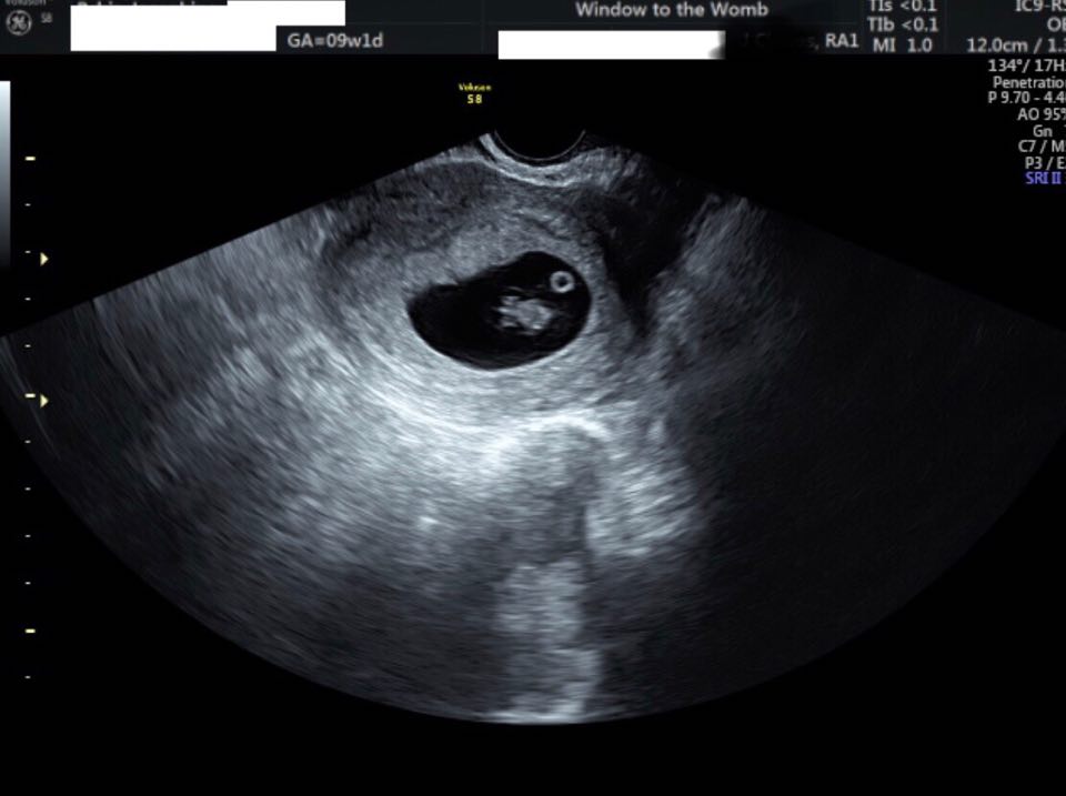 Previous Ectopic Pregnancy Scan