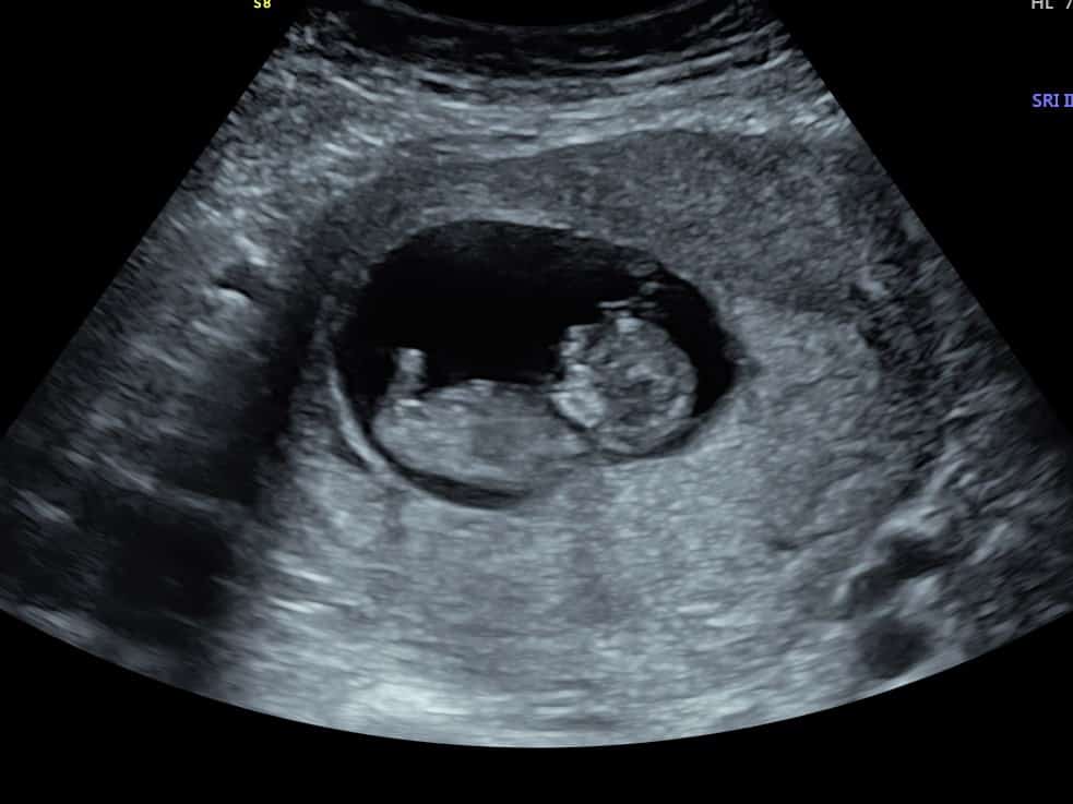 7 week pregnancy scan